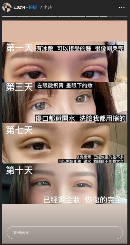 ▲青青公開自己恢復期每一階段的照片。(圖/青青IG)