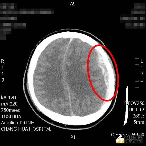 ▲第一次術前電腦斷層圖，可看到左側(紅圈處)有一塊白色紡錘狀的血塊。（圖／記者陳雅芳攝，2020.11.19）