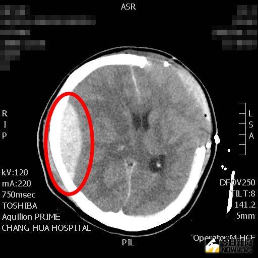 ▲第二次術前電腦斷層圖，可看到右側(紅圈處)有一塊白色紡錘狀的血塊。（圖／記者陳雅芳攝，2020.11.19）