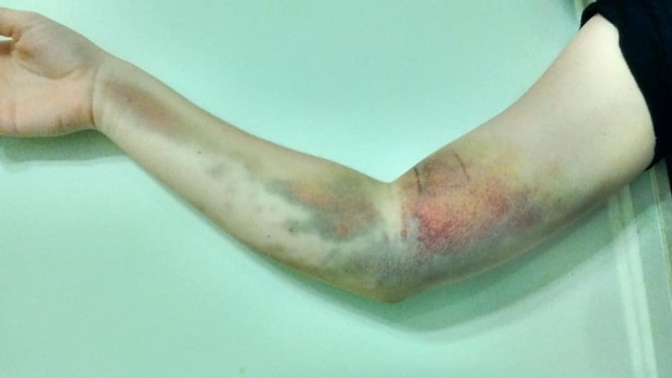 ▲加拿大一位女子捐血時被誤插動脈，竟引發出嚴重罕病後遺症，4年過去手仍伸不直。（圖／翻攝自Gabriella Ekman的推特）