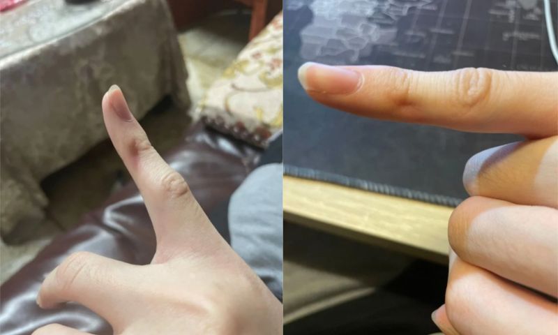▲原PO發出兩張小拇指被新手機壓得變形的照片。（圖／翻攝自《Dcard》）