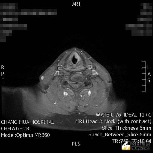▲核磁共振影像，箭頭處為聲帶處的腫瘤。（圖／記者陳雅芳攝，2020.11.27）