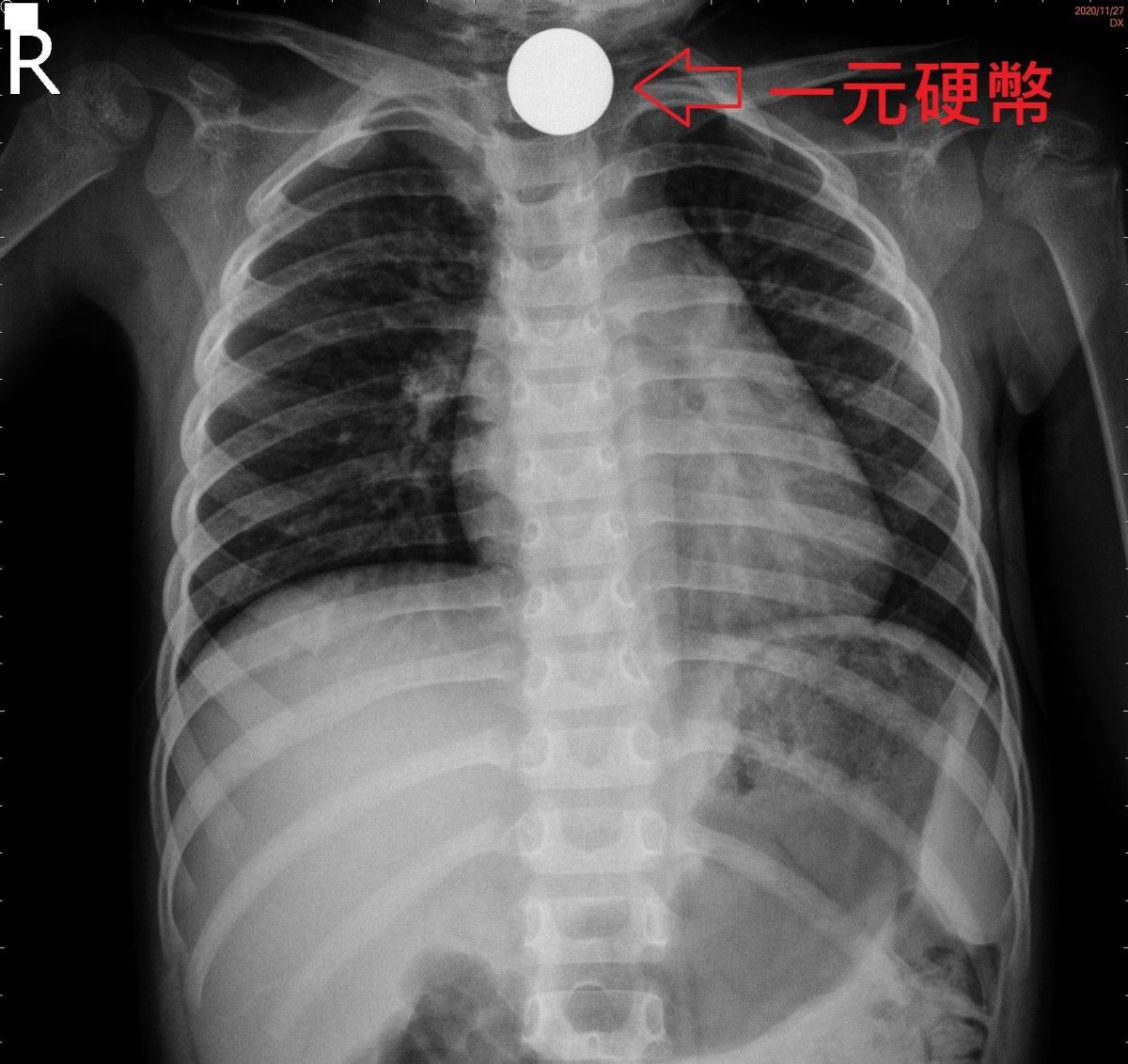 ▲二歲女童吞硬幣卡在頸部食道下不去。（圖／羅東聖母醫院提供)