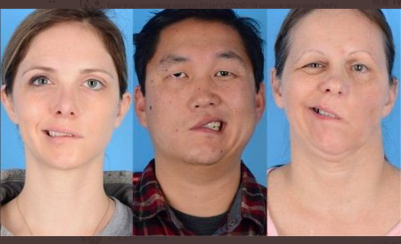 輝瑞疫苗接種後4人出現「眼歪嘴斜」！FDA：應與疫苗無關
