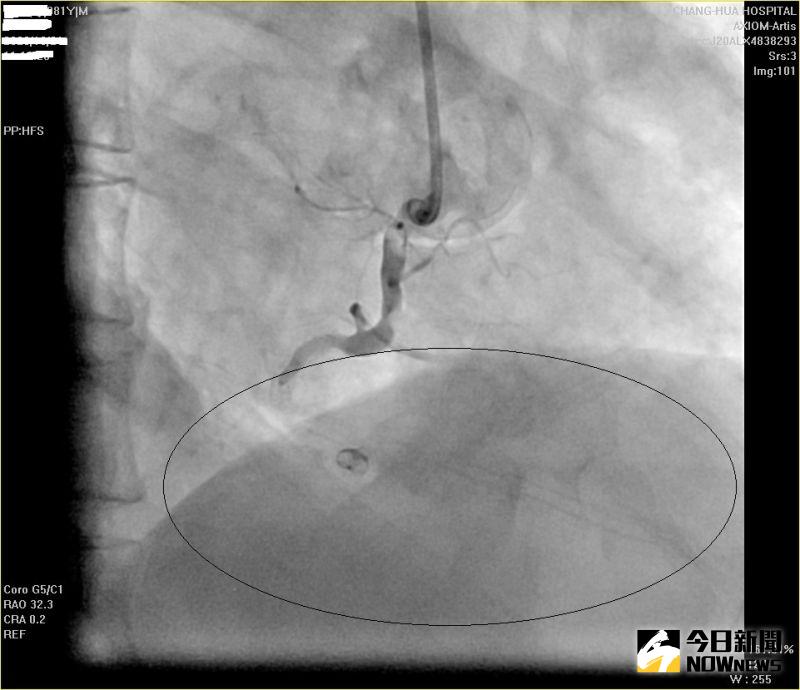 ▲80歲粘姓老翁心血管支架內再狹窄，血流阻塞。（圖／記者陳雅芳攝，2020.12.