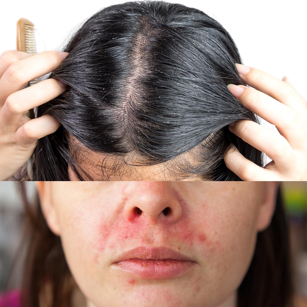 ▲除了頭皮問題,肌膚也有換季困擾!(圖/Shutterstock)