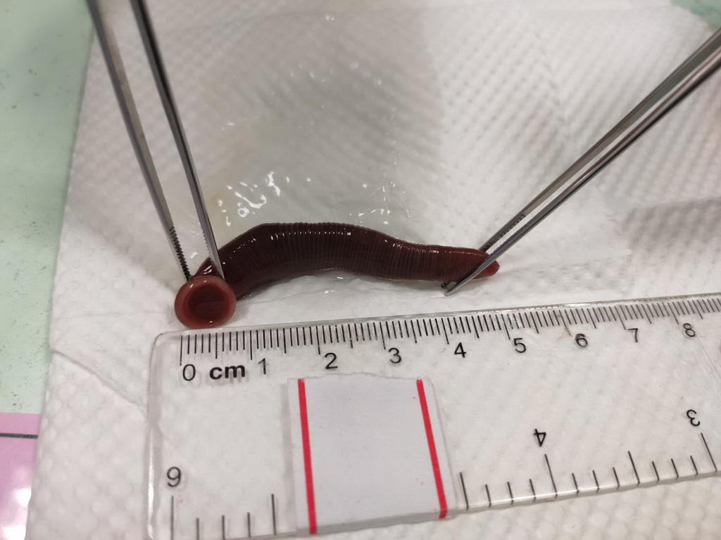 ▲醫師透過內視鏡以長柄鼻咽器械，將水蛭從男子鼻裡取出(圖／醫院提供2021.1.13)