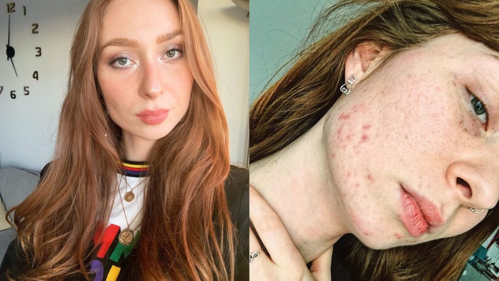 ▲英國化妝師Ivana Kostova不化一毛錢就治好滿臉痘。（圖／VOGUE提供）