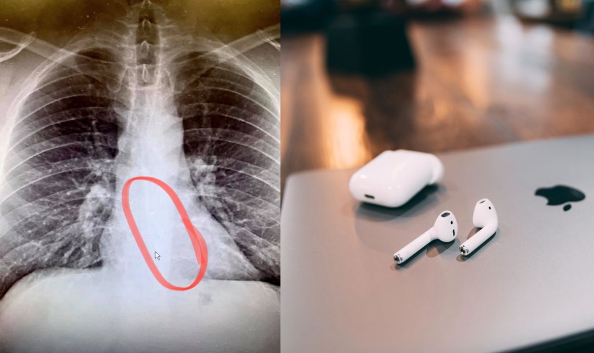 ▲美國一名男子戴著Airpods入睡，豈料醒來一邊耳機不見了，後來居然在肚子裡發現耳機。（左圖，翻攝自Bradford Gauthier Facebook／右示意圖，取自unsplash）