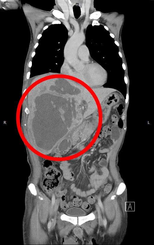 ▲衛生福利部臺北醫院表示，63歲的陳先生因生食，導致的肝膿瘍範圍長達21.31公分。（圖／衛生福利部臺北醫院提供）