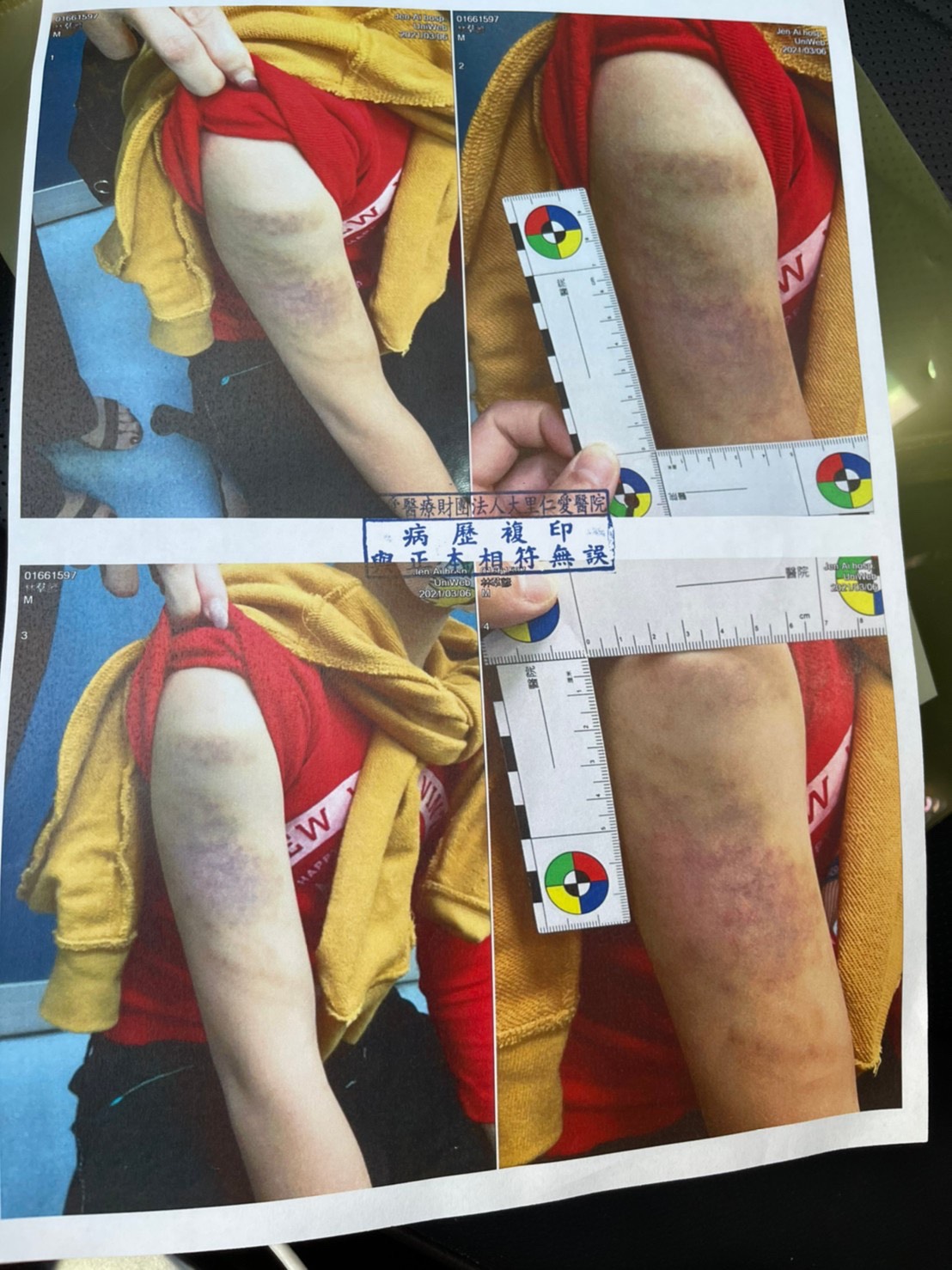 ▲中市知名連鎖補習班，上課時突發性情緒失控，連續毒打學生近十下，造成大面積瘀傷(圖／鄭功進提供2021.3.24)