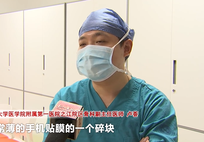 ▲浙江大學附屬第一醫院的骨科主任醫師盧薈檢查後發現,當事人手指的骨頭上仍殘留一塊約5mm×2mm保護貼碎片,導致神經瘤增生,手才會持續感受到劇痛且無力。(圖/翻攝《杭州電視台》微博)