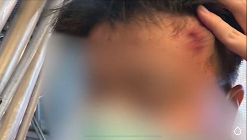 ▲德雷莎被非裔女持鐵鎚爆頭,因此縫了7針。(圖/翻攝abcNews)