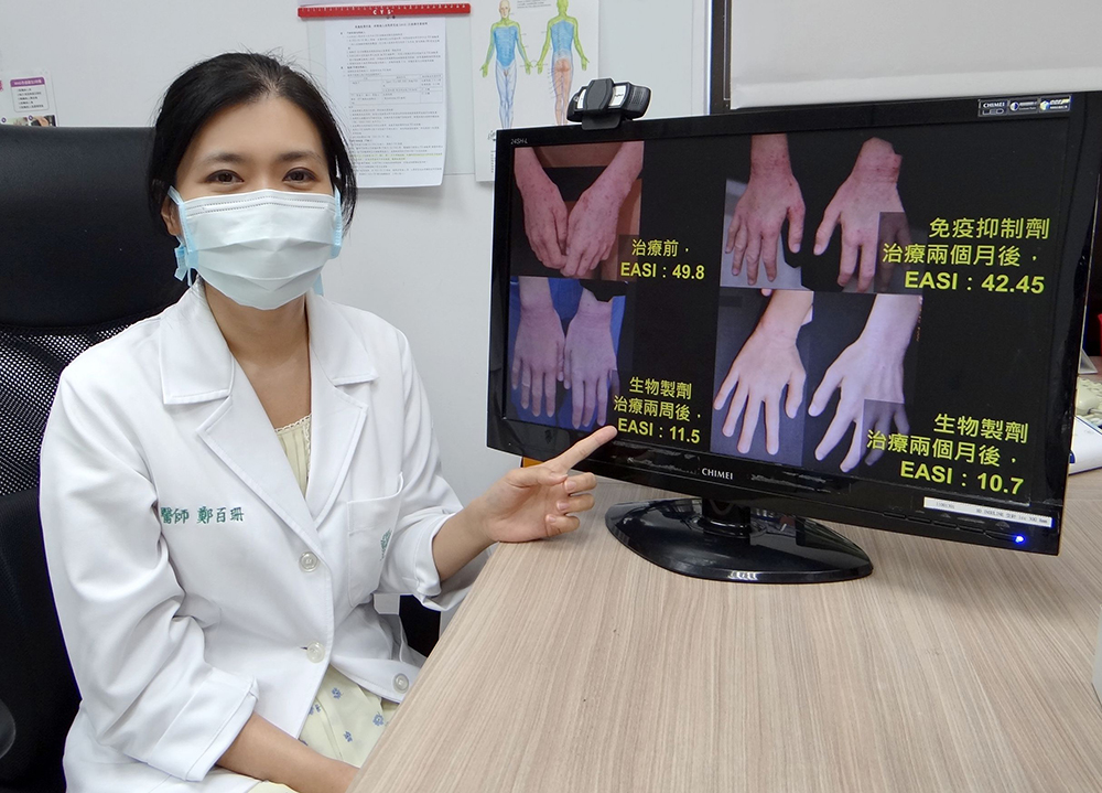 ▲奇美醫學中心皮膚科主治醫師鄭百珊表示，異位性皮膚炎不只影響生理，更會影響心理（圖／奇美醫學中心提供）