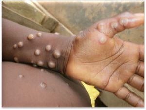 ▲英國威爾斯近日出現2起「猴痘病毒」(Monkeypox)感染案例。資料照。(圖/翻攝自世衛官網) ▲英國威爾斯近日出現2起「猴痘病毒」(Monkeypox)感染案例。資料照。(圖/翻攝自世衛官網)