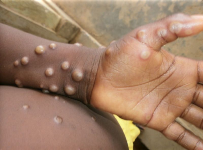 ▲法蘭西島大區（Île-de-France）出現首例兒童感染猴痘。資料照非當事孩童。（圖／翻攝自世衛官網）