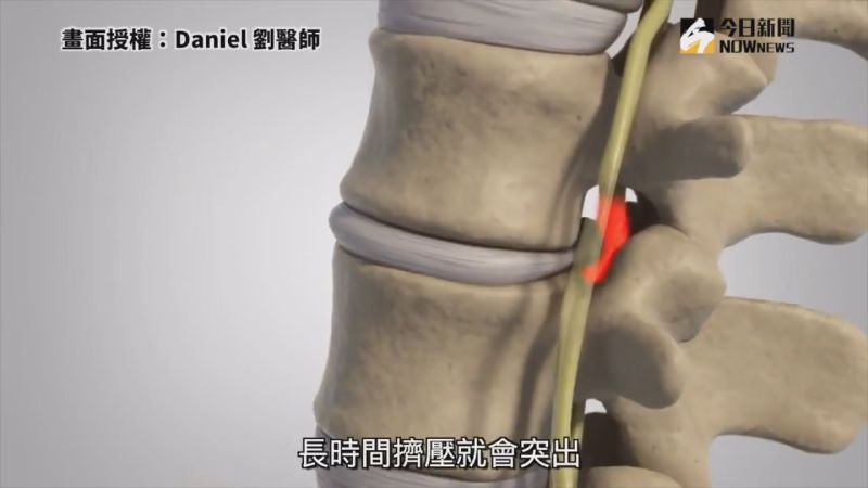 ▲劉醫師詳細說明為什麼會有椎間盤突出問題。(圖／Daniel