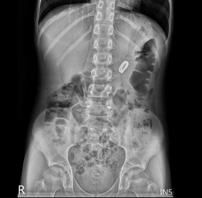 ▲男童誤吞32顆磁力球 ，X光顯示異物位於上腹部。（圖／中國附醫提供）