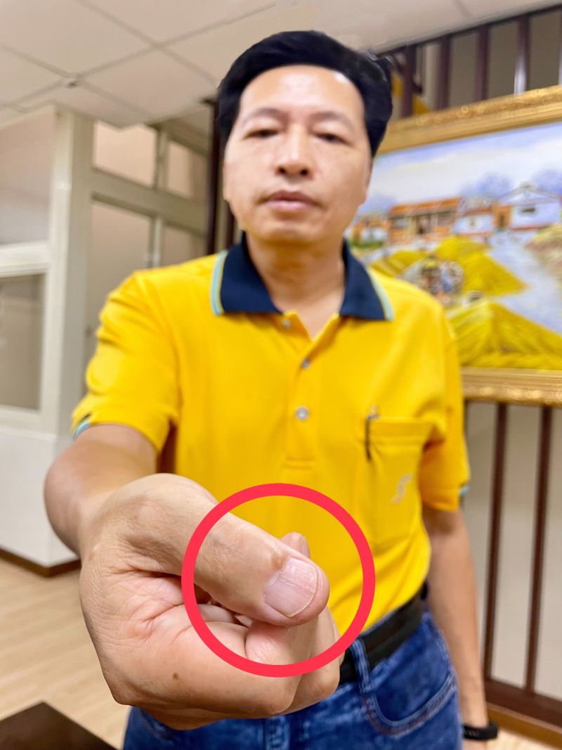 ▲鄭寶清秀出自己右手疤痕,正是數十年前在變壓器工廠打工的「切身之痛」。(圖/鄭寶清服務處提供)