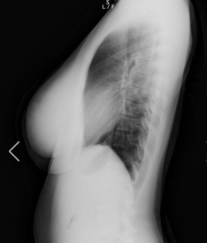 ▲▼天木純出示X光片，強調胸部沒有後天加料。（圖／天木純IG）
