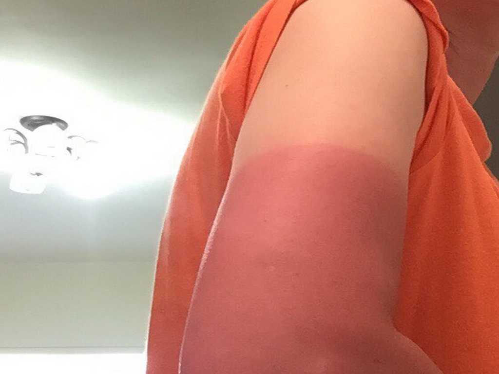 ▲中市婦人挑戰合歡東峰成功攻頂後開心下山，發現纖纖玉手秒變乳豬手(圖／醫院提供2021.8.21)