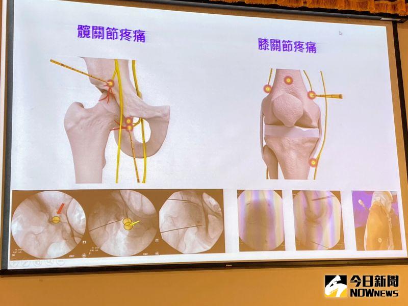 ▲中國附醫疼痛中心利用水冷式射頻為婦人治療雙腳髖關節痛，成效顯著。（圖／記者金武鳳攝，2021.9.15)