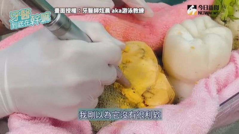 ▲因為拔智齒可能會碰撞其它牙齒,因此需將部分智齒先切碎。(圖/牙醫師炫晨