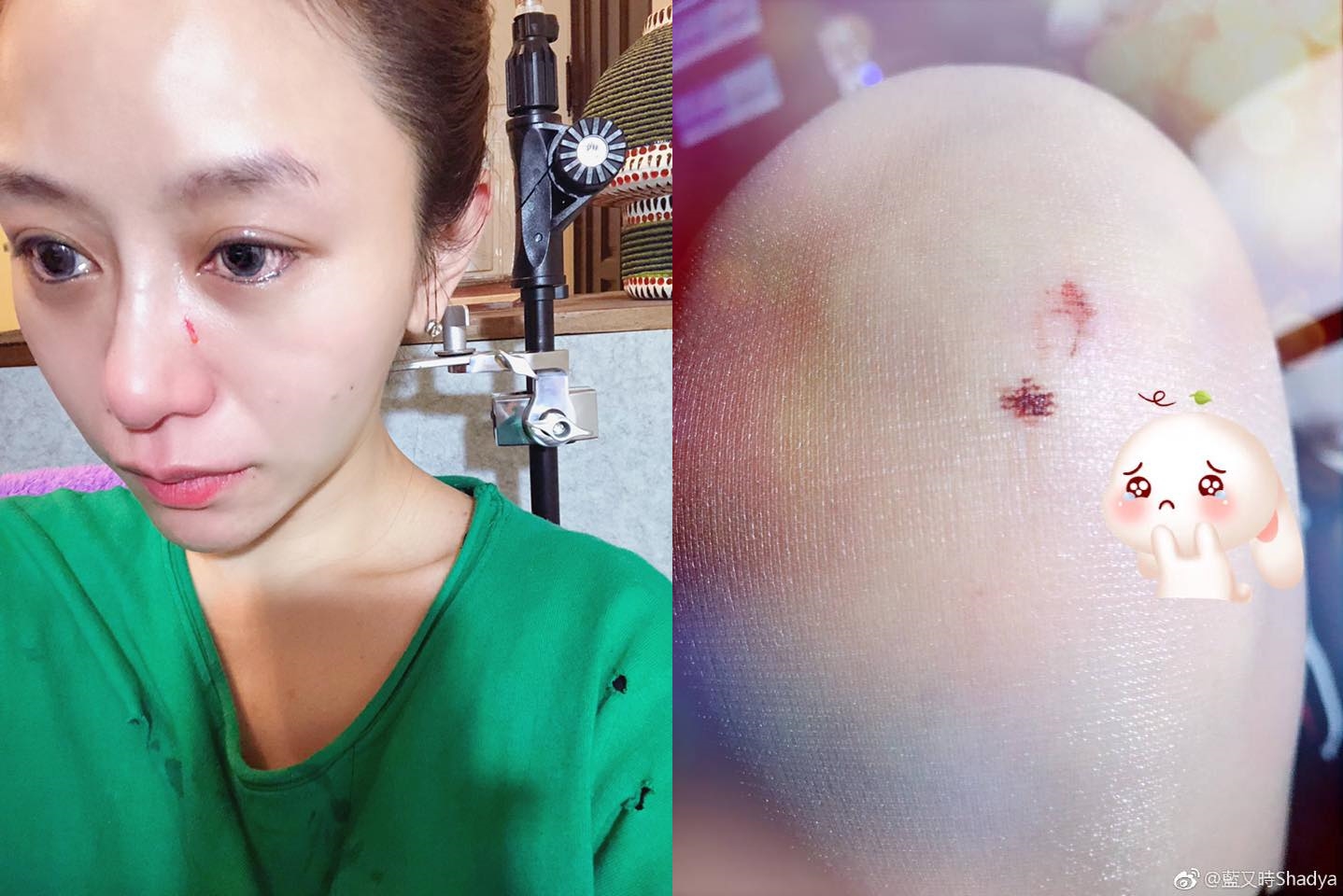 ▲藍又時2018年曾在臉書貼出受傷照片，疑似遭家暴留下傷痕。（圖／翻攝藍又時臉書）