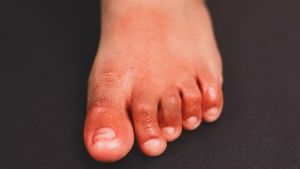 「新冠腳趾」患者腳部浮腫難穿鞋　歐洲新研究找原因
