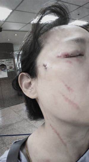 受害人提醒鄰居戴口罩 ▲受害人提醒鄰居戴口罩,遭到挖眼、砍傷(圖/取自《爆料公社》)