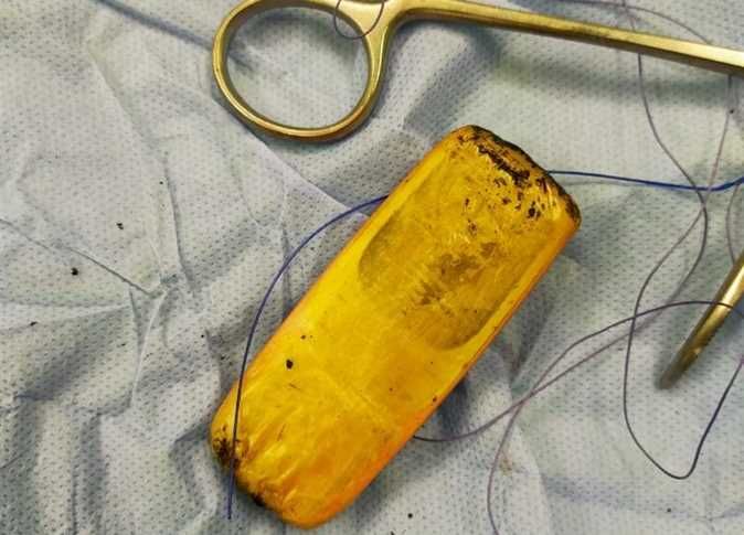 ▲埃及亞斯文大學醫院（Aswan University Hospital）近日收治一名男病患，透過X光檢查竟發現男子腹中竟卡了台「完整手機」將近6個月。（圖／翻攝自推特@khaberni）