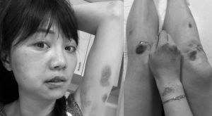 ▲高嘉瑜遭林秉樞毆打,臉腫到「自己都不認識」,一度覺得「我快死了」。(圖/高嘉瑜辦公室提供) ▲高嘉瑜遭林秉樞毆打,臉腫到「自己都不認識」,一度覺得「我快死了」。(圖/高嘉瑜辦公室提供)