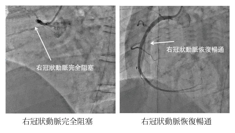 ▲一名男子突發性心肌梗塞,到院前右側冠狀動脈完全阻塞,所幸經醫師實施心導管,裝上支架之後才恢復血液流通。(圖/澄清醫院提供)