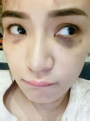 ▲陳沂進行眼部醫美。(圖/陳沂臉書) ▲陳沂進行眼部醫美。(圖/陳沂臉書)