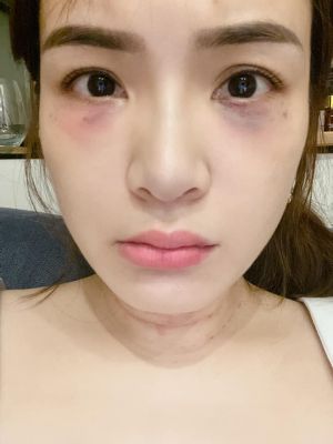 ▲第二天瘀青漸漸擴散。(圖/陳沂臉書) ▲第二天瘀青漸漸擴散。(圖/陳沂臉書)