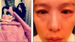 ▲徐若瑄以前因為過敏，整張美麗臉蛋都腫了起來。（圖／翻攝IG）