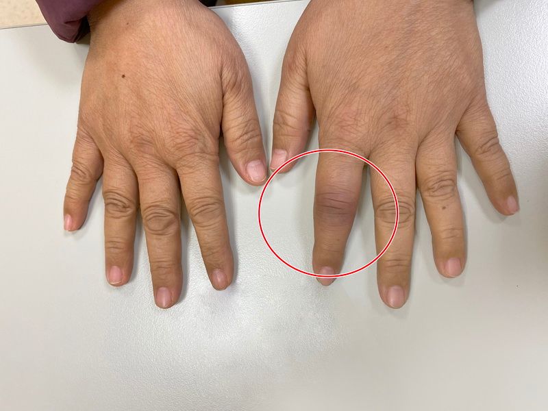 乾癬性關節炎上身　「香腸指」滑手機超痛
