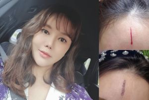 ▲朴妍秀掛彩。(圖/朴妍秀IG) ▲朴妍秀掛彩。(圖/朴妍秀IG)