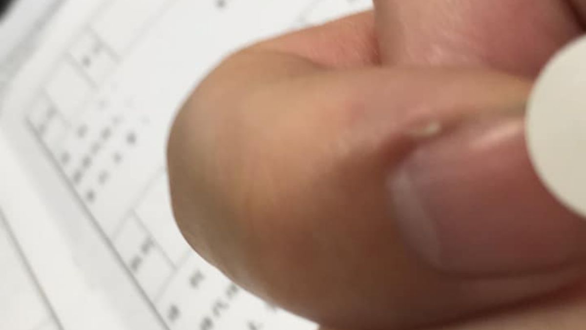 ▲指甲旁邊長神秘白點，網友怕爆急勸：千萬別撕。（圖／爆怨公社）