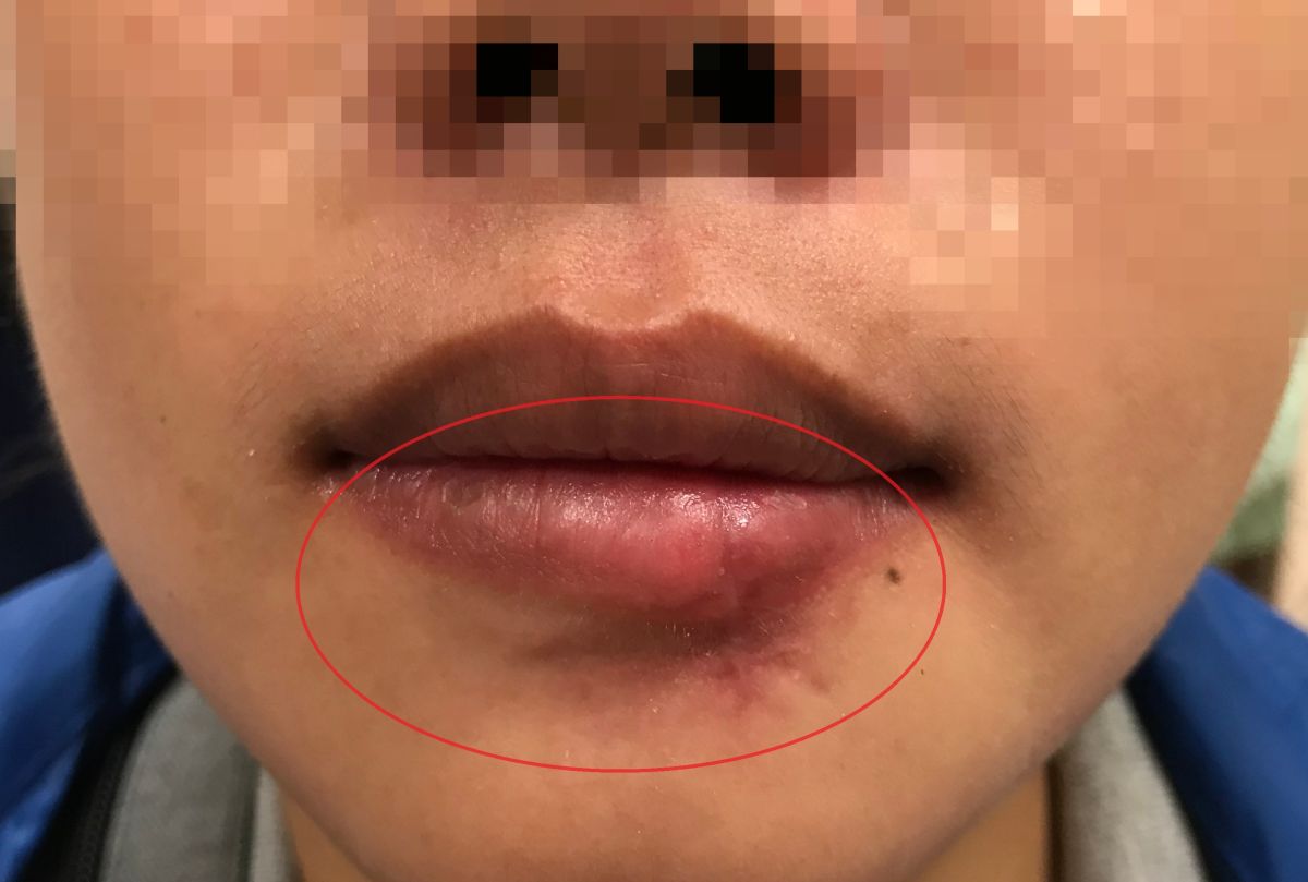 ▲醫師提醒，若是被貓狗不慎被咬傷，必須要立即清洗消毒傷口，並趕緊就醫處理(圖／醫院提供2022.3. 17)