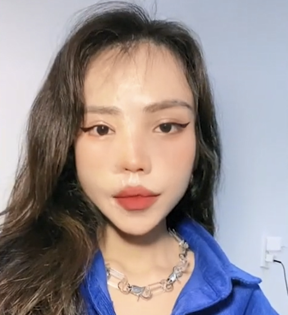 ▲3年來，阿薇經歷了21次手術過程，目前已經逐漸恢復昔日的美麗。（圖／翻攝自tiktok）