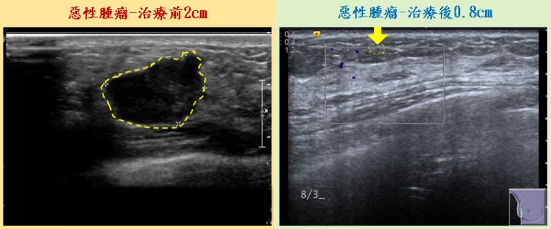 32歲乳癌患者化療及雙標靶 4個月後甩掉癌細胞
