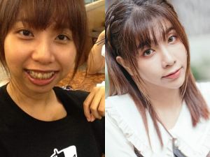 吳夢夢 ▲吳夢夢做過下顎手術,改善牙齒問題。(圖/翻攝吳夢夢臉書)