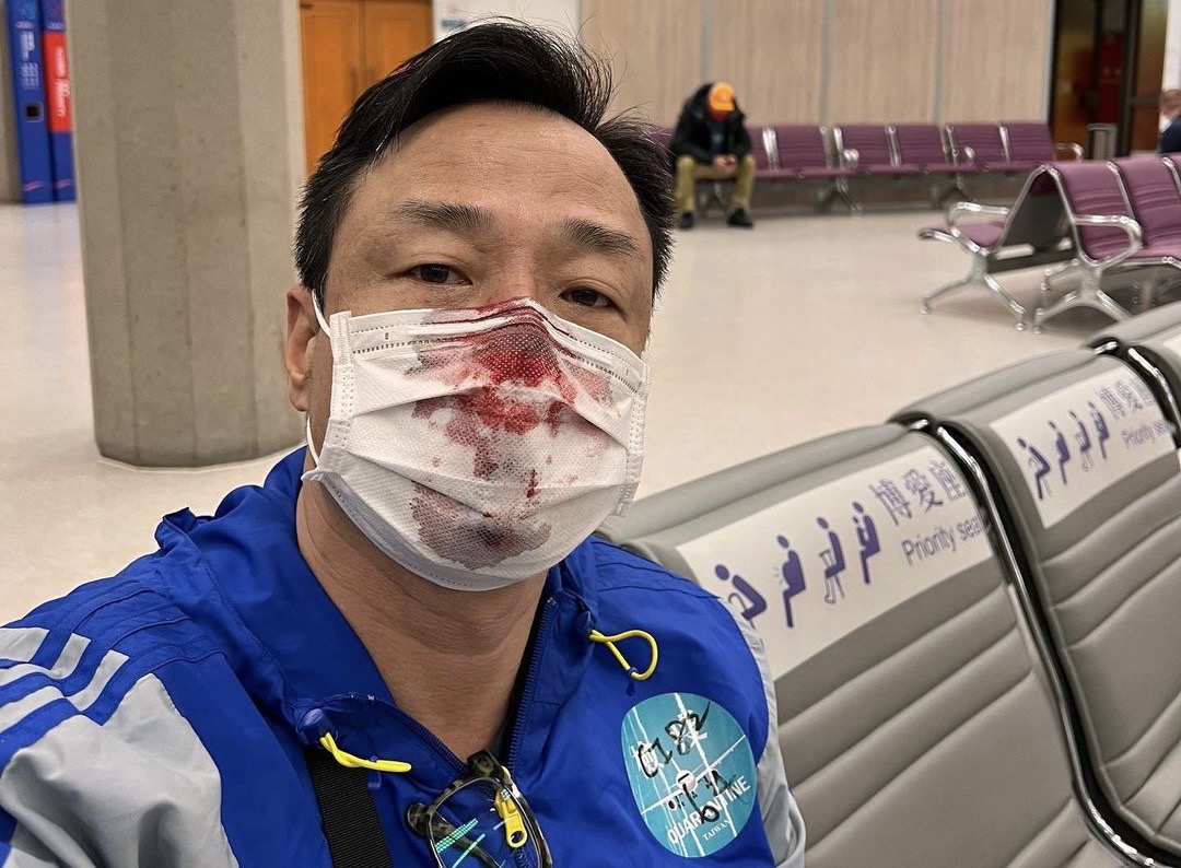 ▲港星王喜3日飛來台灣，入境桃園機場時接受醫護人員PCR篩檢，結果卻爆出採檢時，遭到醫護人員按頭導致右鼻孔受傷，當下血流不止。（圖/王喜臉書）