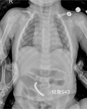 巴克球誤食腸穿孔 ▲(圖/翻攝臉書《來講兒科急診的543-吳昌騰醫師》)