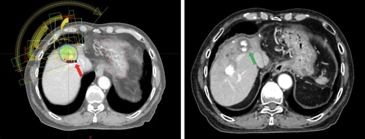 ▲這名75歲的老翁病灶在第8肝葉（紅色箭頭處），經過放射治療與栓塞後，已經無殘存腫瘤（綠色箭頭處）。（圖／澄清醫院提供）