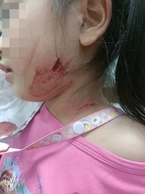 ▲女童臉部受有撕裂傷。（圖／翻攝畫面）