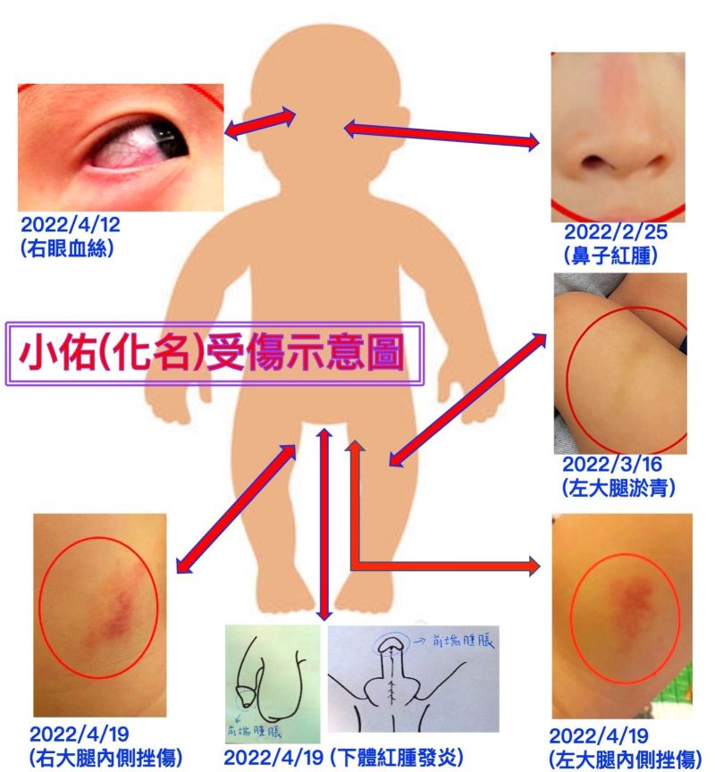 ▲從眼睛、鼻子、大腿到下體,小佑身體多處受傷。(圖/何欣純服務處提供,2022.05.04)