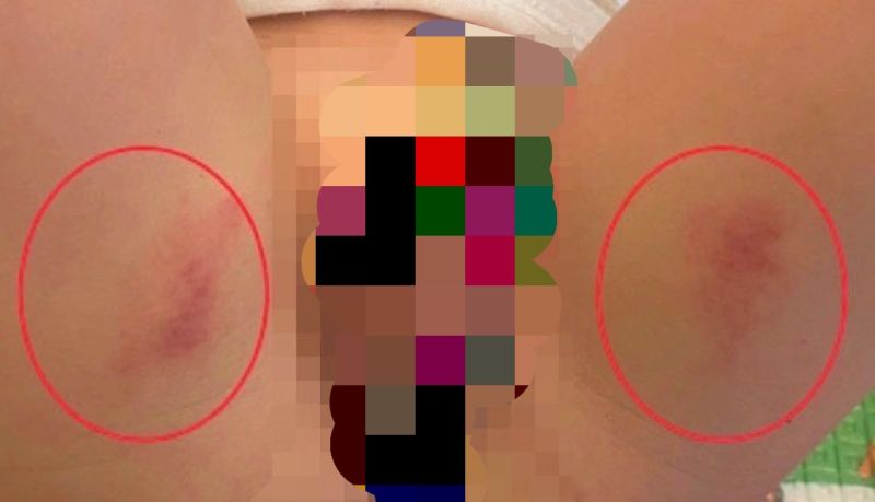 ▲小佑下體和大腿內側紅腫,保母卻說是尿布太濕造成的。(圖/何欣純服務處提供,2022.05.04)