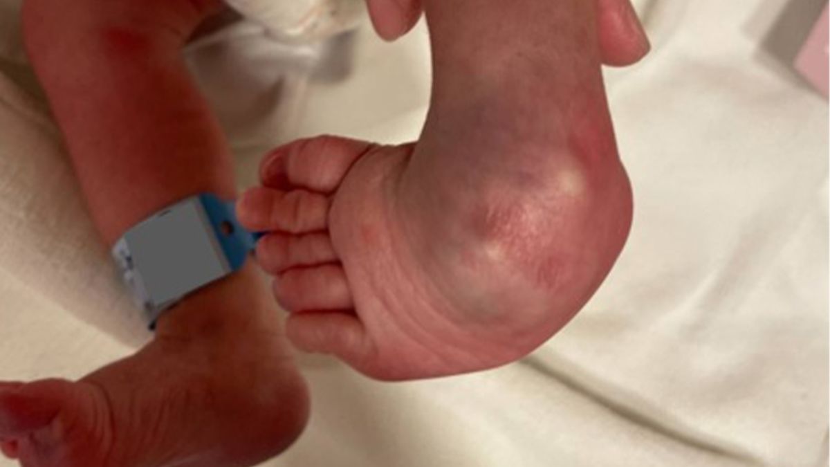 ▲一名男嬰剛出生就被發現左腳出現「先天性馬蹄內翻足」，台中澄清醫院立即幫他製作踝足支架進行矯正治療。（圖／台中澄清醫院提供）